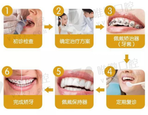 乳牙腔窝沟封闭前注意事项，乳牙窝沟封闭的适宜时间和问题锦集(图1)